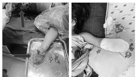 Nhặt pháo rơi, bé gái 5 tuổi mất bàn tay vĩnh viễn