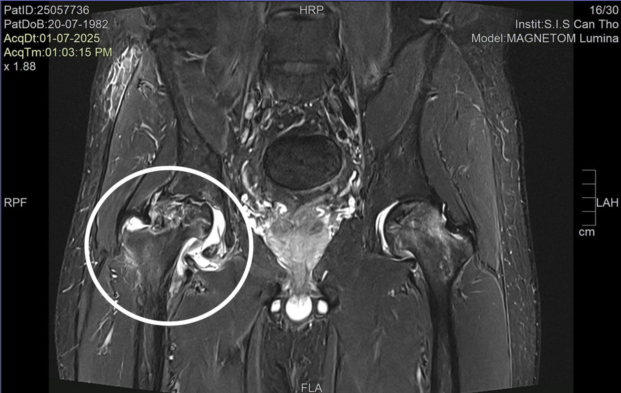 Hình ảnh MRI ghi nhận hoại tử chỏm xương đùi. Ảnh: BVCC. hoai-tu-0.jpg