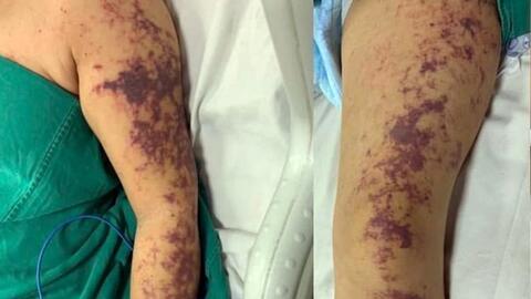 Nhiễm liên cầu khuẩn lợn không chỉ bởi tiết canh