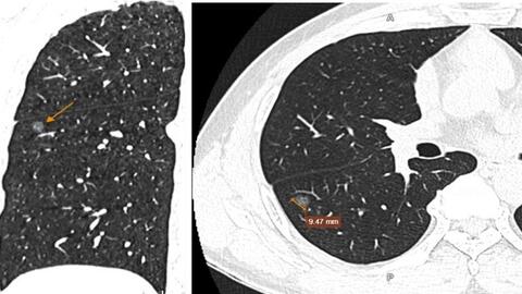 Phát hiện tổn thương giai đoạn tiền ung thư phổi do đau tức ngực phải