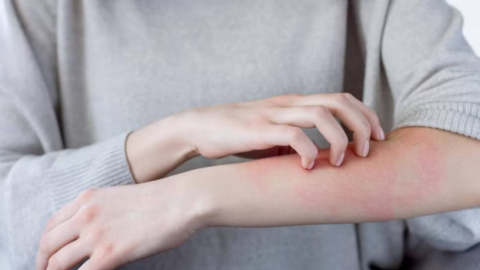 Gợi ý xử lý cháy nắng, chống nắng đúng cách