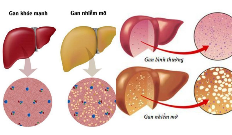 Thực phẩm tốt cho người gan nhiễm mỡ