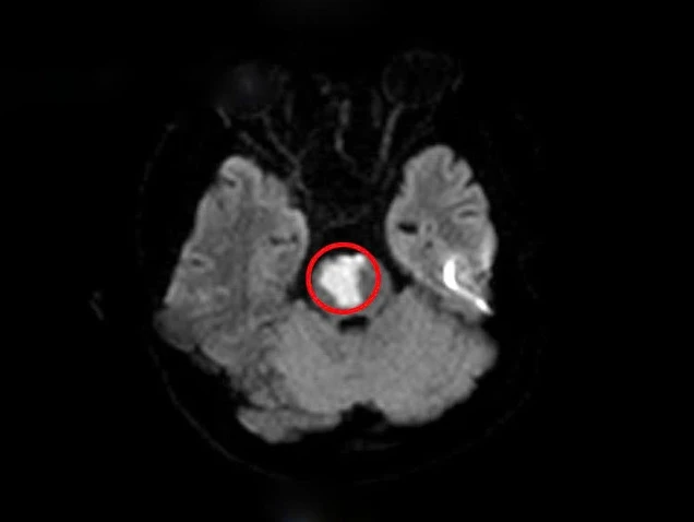 Tổn thương nhồi máu vùng tiểu não của người bệnh (vùng khoanh tròn màu đỏ) - Ảnh: BVCC quy-1.png