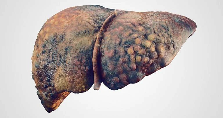Có nhiều nguyên nhân gây xơ gan. Trong đó, xơ gan do rượu chiếm 10 - 20%. Ảnh minh hoạ.
